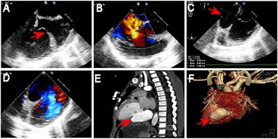 Case report: Traumatic ventricular aneurysm combining tricuspid valve avulsion in a child: Diagnostic findings and treatment protocols